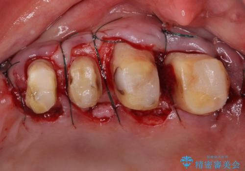 歯肉が腫れて出血する　奥歯の歯周病治療の治療後