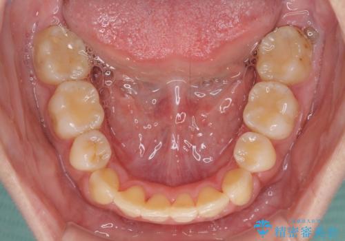 部分矯正で出っ歯になった 出っ歯改善の抜歯矯正の治療後