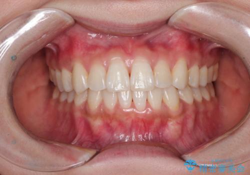 前歯のがたつきと反対咬合 インビザラインによる矯正治療の症例 治療後