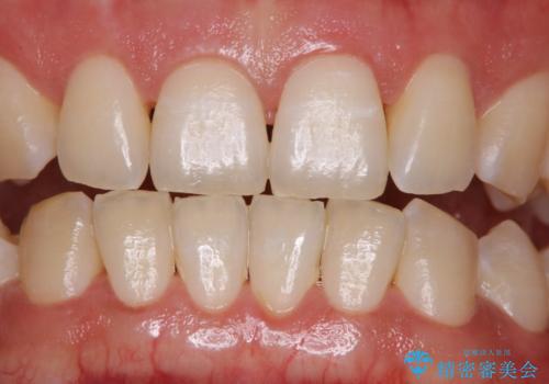 ホワイトニングせずにPMTCで明るい口元に