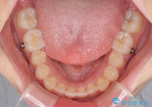 前歯のデコボコを改善 インビザライン矯正の治療中