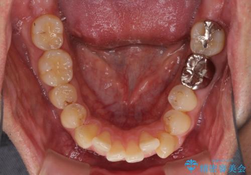 前歯のデコボコと下顎の八重歯 インビザラインによる矯正治療の治療前