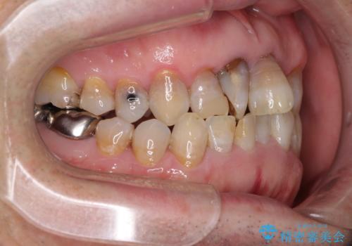 上顎の狭窄歯列 インビザラインによる拡大矯正の治療前