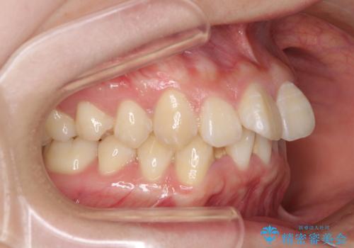 上下前歯の叢生をインビザラインできれいにの治療前