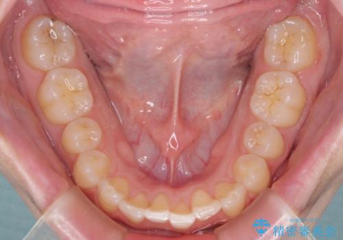 インプラントによる補綴治療とインビザライン矯正の治療中