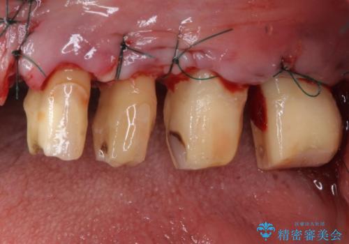 歯肉が腫れて出血する　奥歯の歯周病治療の治療後