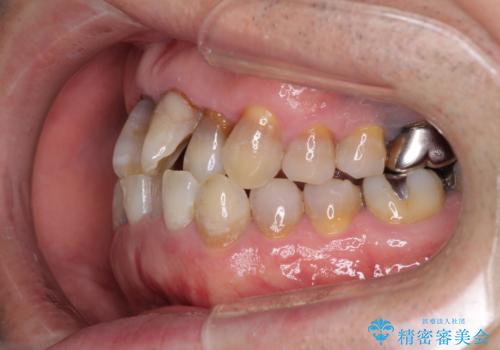 上顎の狭窄歯列 インビザラインによる拡大矯正の治療前