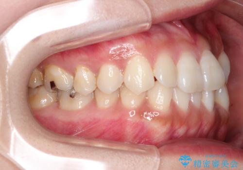 前歯のがたつきと反対咬合 インビザラインによる矯正治療の治療前