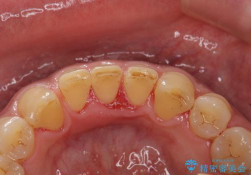 タバコによるヤニをPMTCで除去の症例 治療後