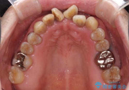 上顎の狭窄歯列 インビザラインによる拡大矯正の治療前