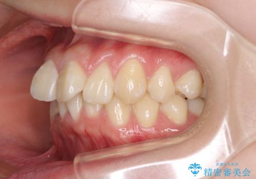 上下前歯の叢生をインビザラインできれいにの治療前