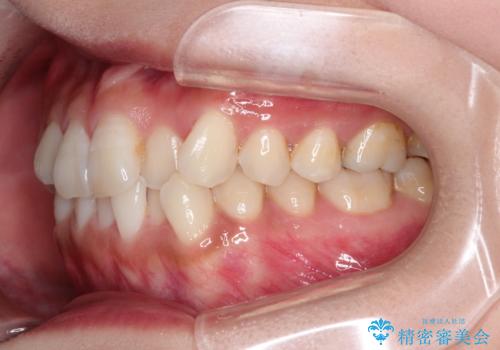 前歯のがたつきと反対咬合　インビザラインによる矯正治療の治療前