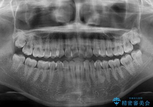 前歯のデコボコを改善 インビザライン矯正の治療前