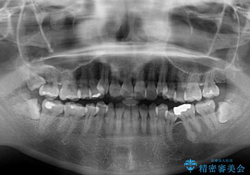 口元の突出感を改善 インビザラインによる非抜歯矯正の治療前