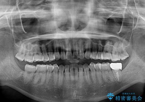 インビザライン・ライトにより後戻りの再矯正の治療前