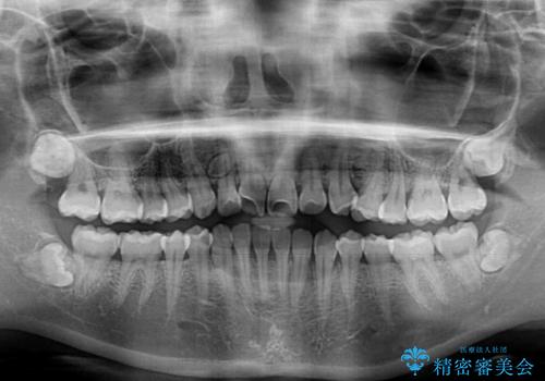 軽微な歯列不正をワイヤー矯正で整えるの治療前