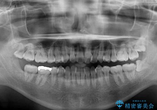 インビザラインが続けられない ワイヤー装置での矯正治療の治療前
