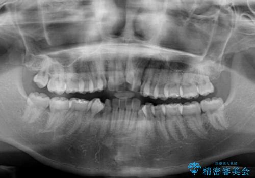 口元をスッキリと ワイヤー装置による抜歯矯正の治療前