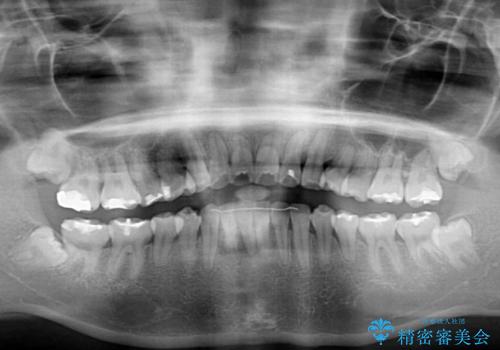 部分矯正で出っ歯になった 出っ歯改善の抜歯矯正の治療前