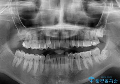 八重歯を短期間で改善　ワイヤー装置による抜歯矯正の治療前