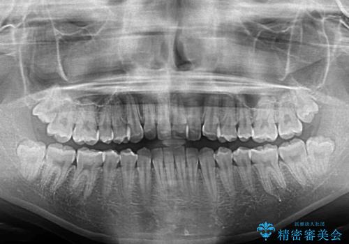 前歯のクロスバイト インビザラインによる矯正治療の治療前
