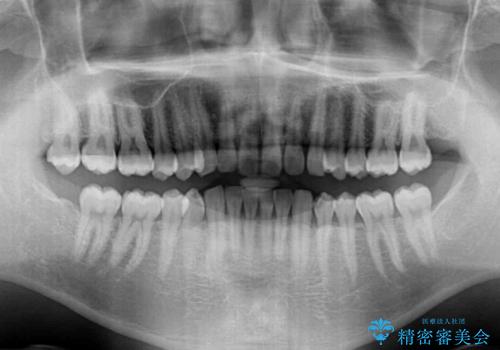 細かい隙間にものがはさまる インビザラインによる矯正治療の治療前