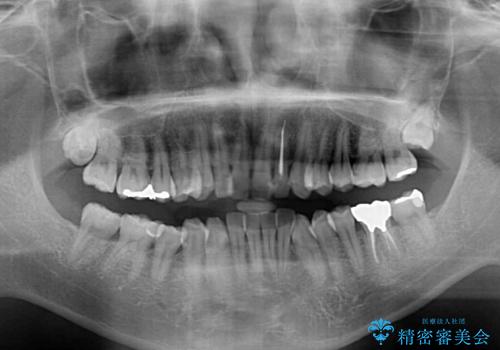 前歯のデコボコと下顎の八重歯 インビザラインによる矯正治療の治療前