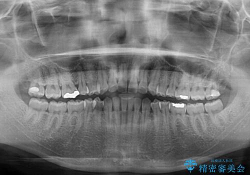 受け口傾向の前歯 すきっ歯の改善の治療前
