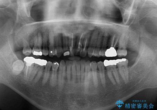 上顎の狭窄歯列 インビザラインによる拡大矯正の治療前