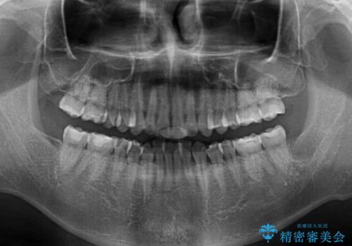 ディープバイトと叢生を解消 インビザライン矯正の治療前
