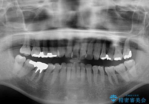 出っ歯を改善した後に真っ白な歯に 矯正歯科治療と審美歯科治療の治療前