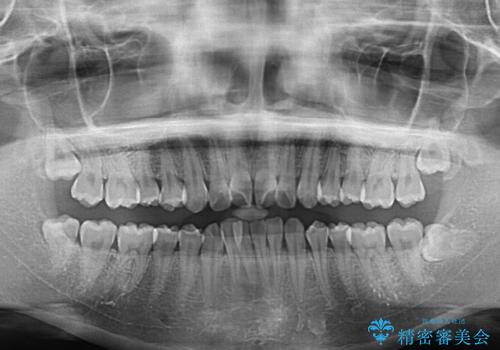 上下前歯の叢生をインビザラインできれいにの治療前