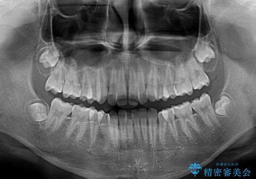 中学生のワイヤー矯正 クロスバイトを短期間で改善の治療前