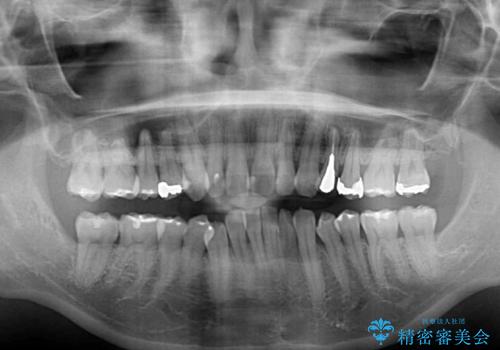 八重歯の再矯正 インビザラインでストレスなく矯正治療の治療前