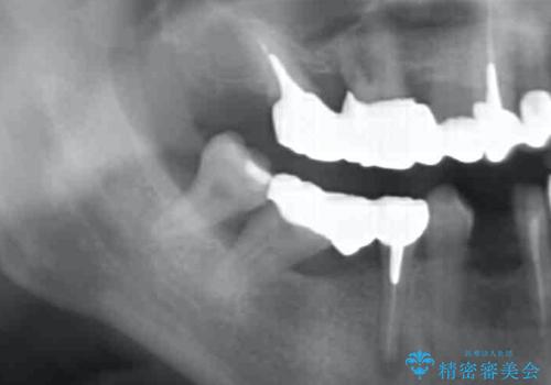 インプラント治療で達成するしっかりと食事できる噛み合わせの治療前
