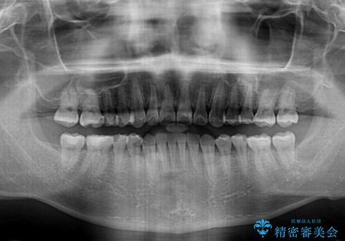 ディープバイトと叢生を解消 インビザライン矯正の治療後