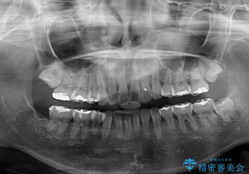 部分矯正で出っ歯になった 出っ歯改善の抜歯矯正の治療後