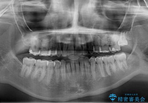 八重歯を短期間で改善　ワイヤー装置による抜歯矯正の治療後