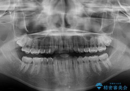 前歯のクロスバイト インビザラインによる矯正治療の治療後