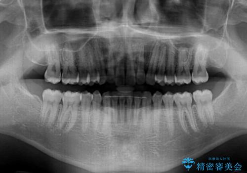 細かい隙間にものがはさまる インビザラインによる矯正治療の治療後