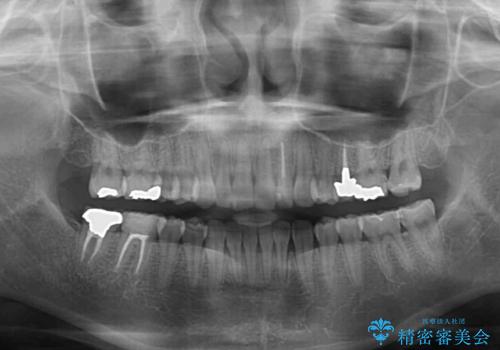 軽度の叢生をインビザライン・ライトで解消の治療後