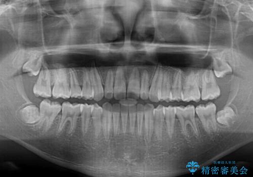中学生のワイヤー矯正 クロスバイトを短期間で改善の治療後