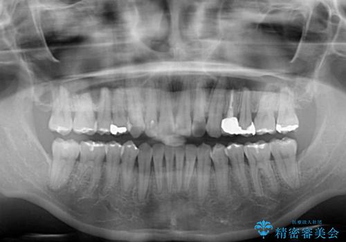 八重歯の再矯正 インビザラインでストレスなく矯正治療の治療後