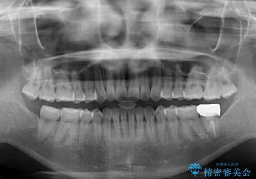 インビザライン・ライトにより後戻りの再矯正の治療後