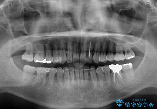 前歯のデコボコと下顎の八重歯 インビザラインによる矯正治療の治療後