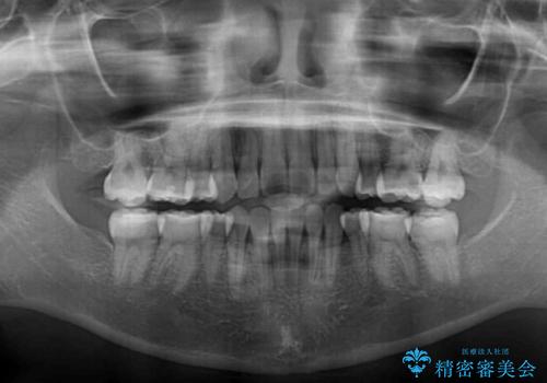 前歯の正中のズレを改善　目立たないワイヤー装置での抜歯矯正の治療後