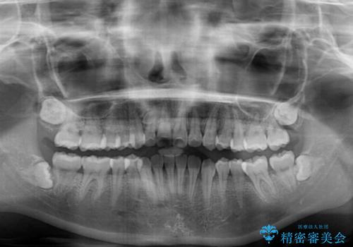 軽微な歯列不正をワイヤー矯正で整えるの治療後