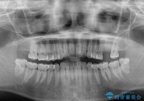 インプラントによる補綴治療とインビザライン矯正の治療前