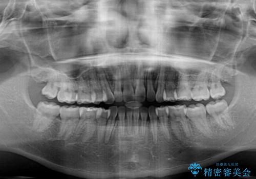 口元をスッキリと ワイヤー装置による抜歯矯正の治療後
