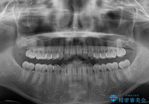 前歯のデコボコを改善 インビザライン矯正の治療後